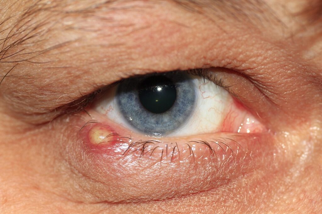 nyheterinflammation missades har lex maria anmalts d901cd40